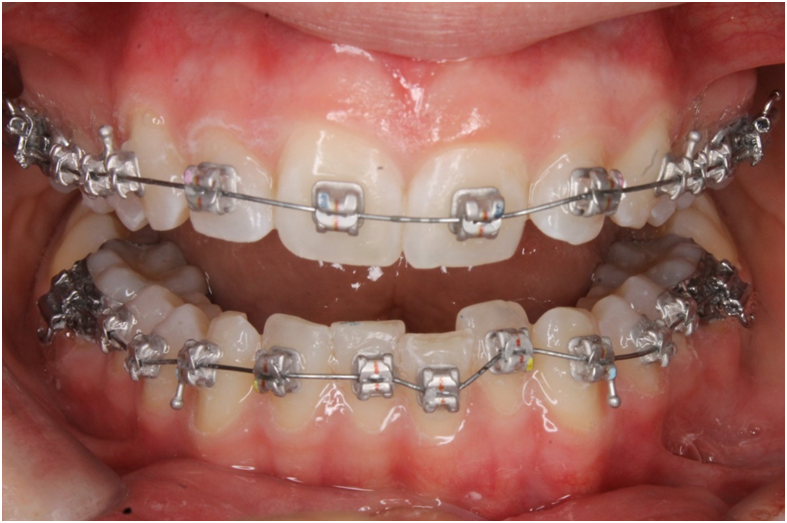 Feste Zahnspange mit selbstligierenden rhodinierten Minibrackets